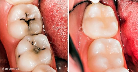 پرشدگی اسیب دیده دندان